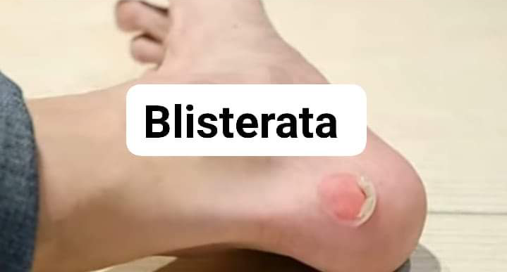 Blisterata: Unveiling the Enigmatic World of Blisters